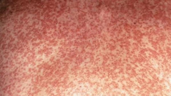 A measles rash can develop a<em></em>bout four days after initial symptoms appear. Supplied